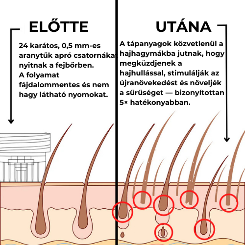 GROW-Arany mikrotűs hajnővesztő kezelés