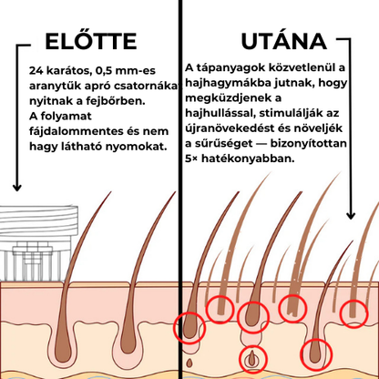 GROW-Arany mikrotűs hajnővesztő kezelés