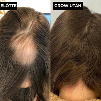 GROW-Arany mikrotűs hajnővesztő kezelés