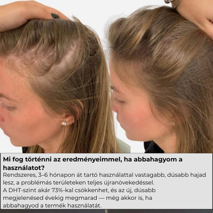 GROW-Arany mikrotűs hajnővesztő kezelés